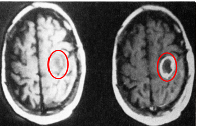 MRI scan of a brain