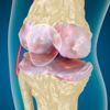 Osteoarthritis : Knee , x-ray
