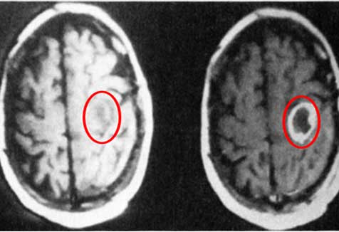 MRI image of a brain